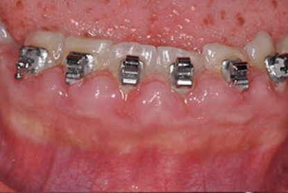 Close up of mouth with braces after pocket reduction treatment