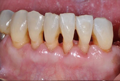 Close up of mouth before pocket reduction treatment