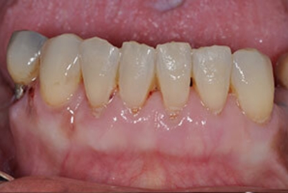 Close up of mouth after pocket reduction treatment