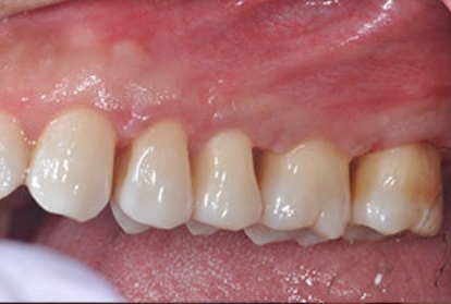 Close up of mouth before pocket reduction treatment