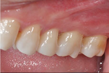 Close up of mouth after pocket reduction treatment