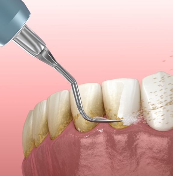 Illustrated dental scaler removing plaque buildup from teeth and gums