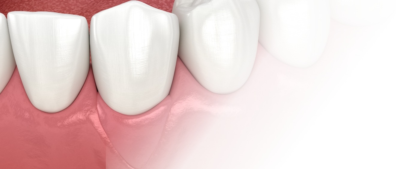 Illustration of row of lower teeth after soft tissue grafting