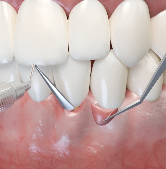 Illustrated dental tools performing a gum tissue graft