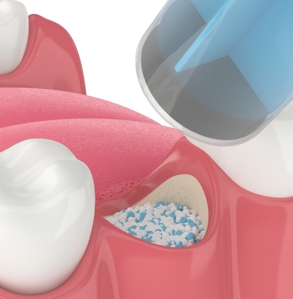 Illustrated bone grafting material being placed in socket after tooth extraction