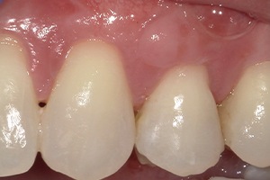 Gallery Gum Grafting | Periodontal Therapy | Smile Restoration