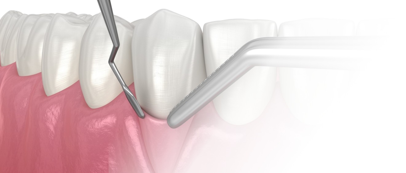 Illustrated gum tissue being grafted in front of tooth with receding gums