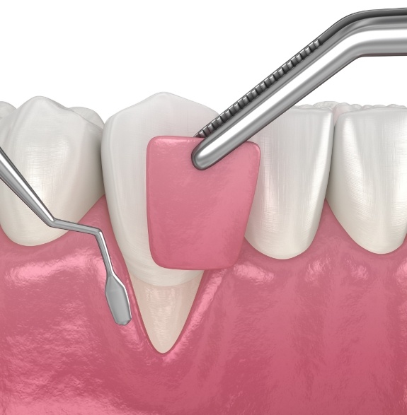 Illustration of gum graft being performed