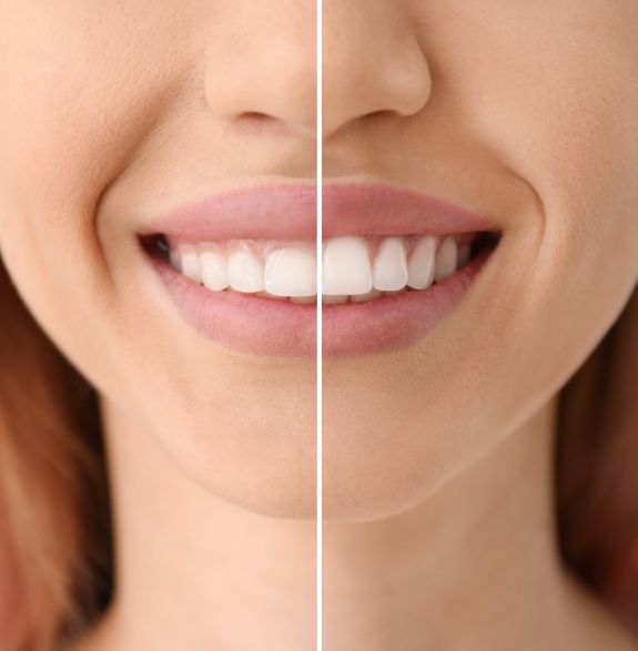 Close up of woman smiling before and after gummy smile correction