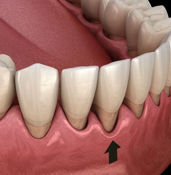 Illustrated lower arch of teeth with receding gums and an arrow pointing upward from the gums to the teeth