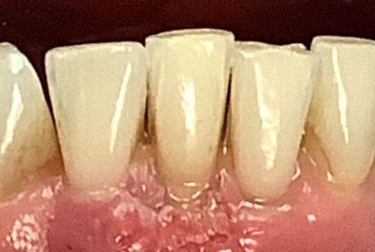 Close up of mouth after gum grafting