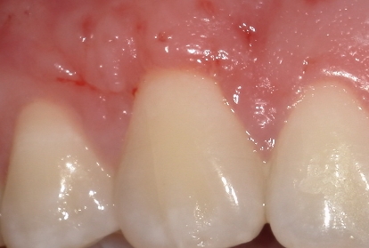 Close up of tooth with even gums after gum grafting