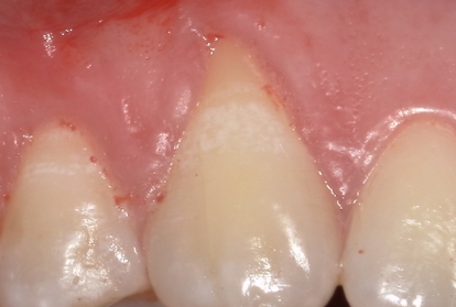 Close up of tooth with receding gums