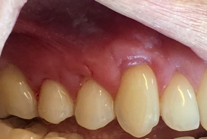 Close up of mouth after gum grafting