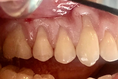 Close up of mouth before gum grafting