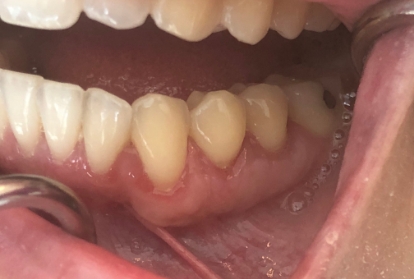 Close up of mouth after gum grafting