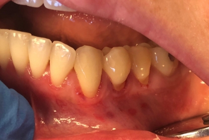 Close up of mouth before gum grafting