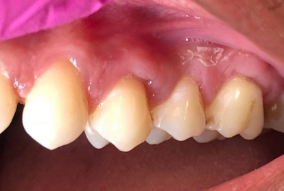 Close up of mouth after gum grafting