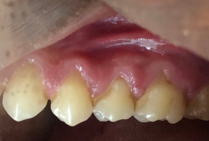 Close up of mouth before gum grafting