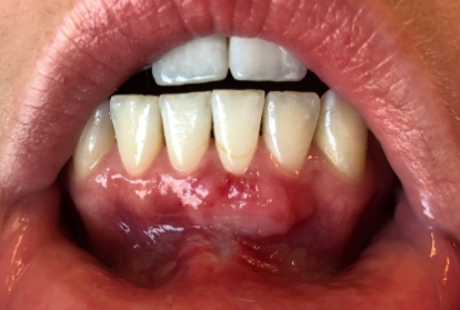 Close up of mouth after gum grafting