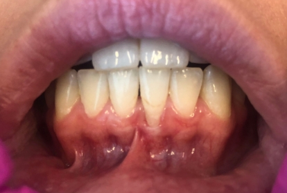 Close up of mouth before gum grafting