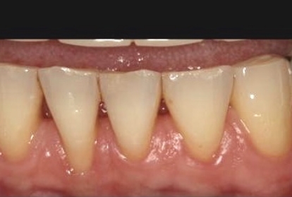 Close up of mouth before gum grafting