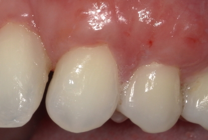 Two teeth after treating gum recession