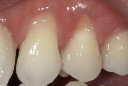 Two teeth in receding gums