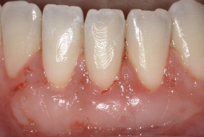 Close up of mouth after gum grafting