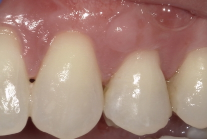 Close up of mouth after gum grafting