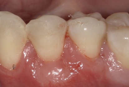 Close up of mouth after gum grafting