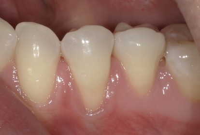 Close up of mouth before gum grafting