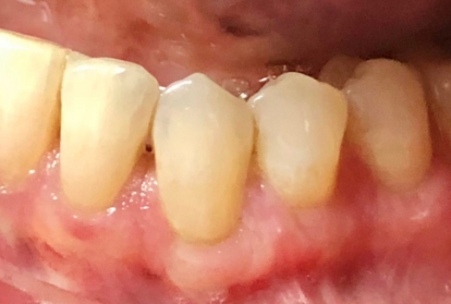 Close up of mouth after gum grafting