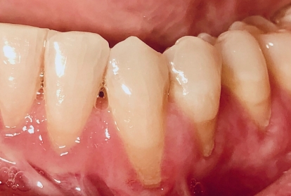 Close up of mouth before gum grafting