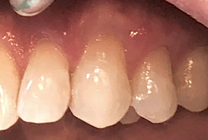 Close up of mouth after gum grafting