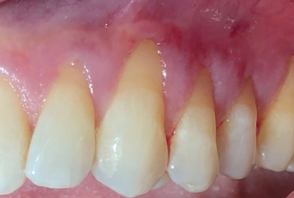 Close up of mouth before gum grafting