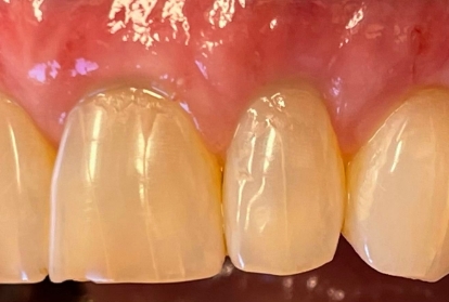 Close up of mouth after gum grafting