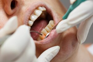 Dental laser targeting infected gum tissue