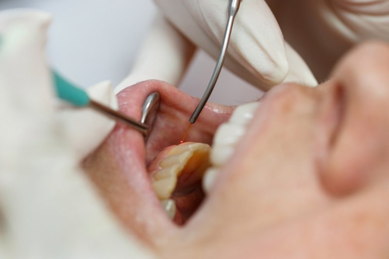 Dentist using a dental laser