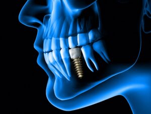 Digital model of a dental implant